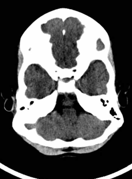Cerebellar abscess (Radiopaedia 73727-84527 Axial non-contrast 26).jpg