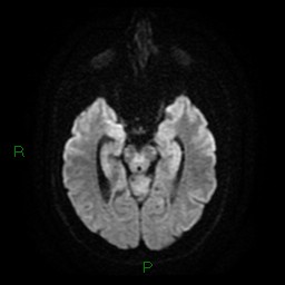 Cerebellar abscess (Radiopaedia 78135-90678 Axial DWI 13).jpg