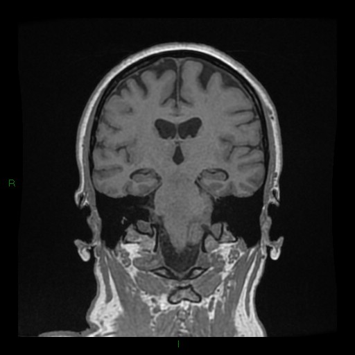 File:Cerebellar abscess (Radiopaedia 78135-90678 Coronal T1 C+ 91).jpg