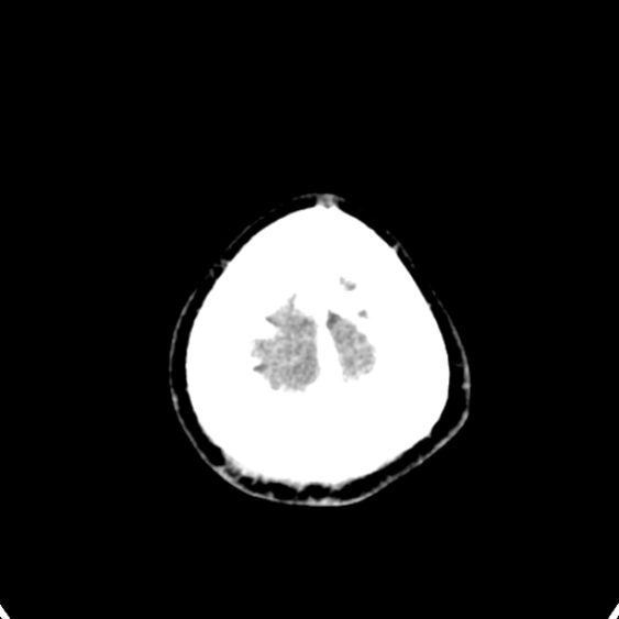 Cerebellar abscess secondary to mastoiditis (Radiopaedia 26284-26412 Axial C+ delayed 148).jpg