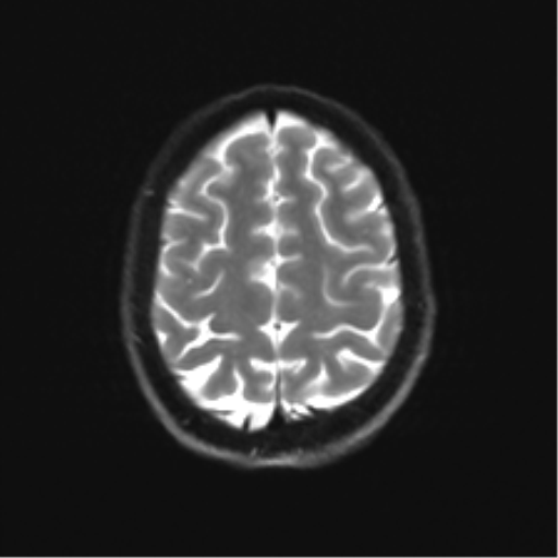 Cerebellar agenesis with hypoplastic pons (pontocerebellar hypoplasia) (Radiopaedia 57224-64138 Axial DWI 31).png