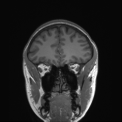 Cerebellar agenesis with hypoplastic pons (pontocerebellar hypoplasia) (Radiopaedia 57224-64138 Coronal T1 70).png