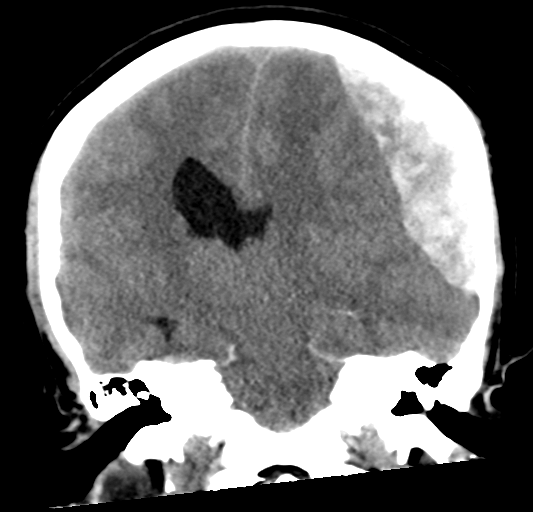File:Cerebellar ependymoma complicated by post-operative subdural hematoma (Radiopaedia 83322-97737 Coronal non-contrast 21).png
