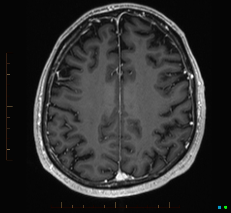 Cerebellar gangliocytoma (Radiopaedia 65377-74422 Axial T1 C+ 100).jpg