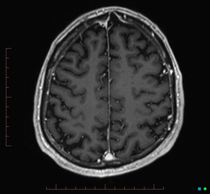 Cerebellar gangliocytoma (Radiopaedia 65377-74422 Axial T1 C+ 108).jpg