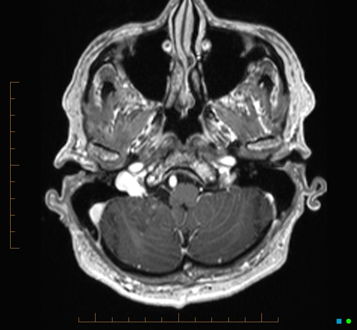 Cerebellar gangliocytoma (Radiopaedia 65377-74422 Axial T1 C+ 12).jpg