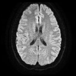 Cerebellar hemangioblastoma (Radiopaedia 29570-30077 Axial DWI 16).jpg