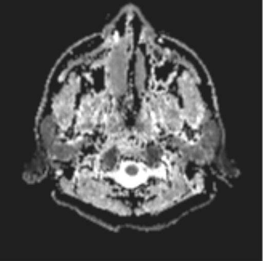 File:Cerebellar hemangioblastomas and pituitary adenoma (Radiopaedia 85490-101176 Axial ADC 1).png