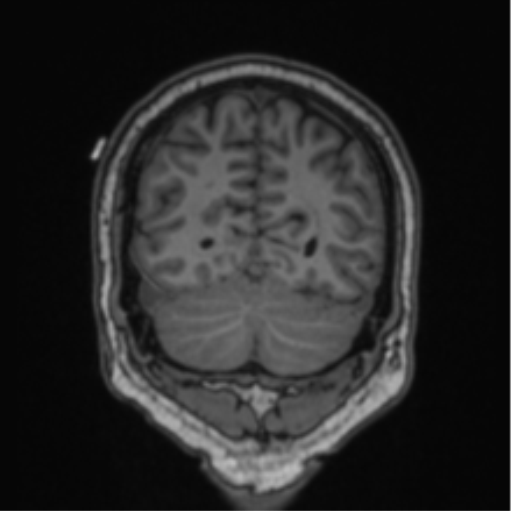 Cerebellar hemangioblastomas and pituitary adenoma (Radiopaedia 85490-101176 Coronal T1 25).png