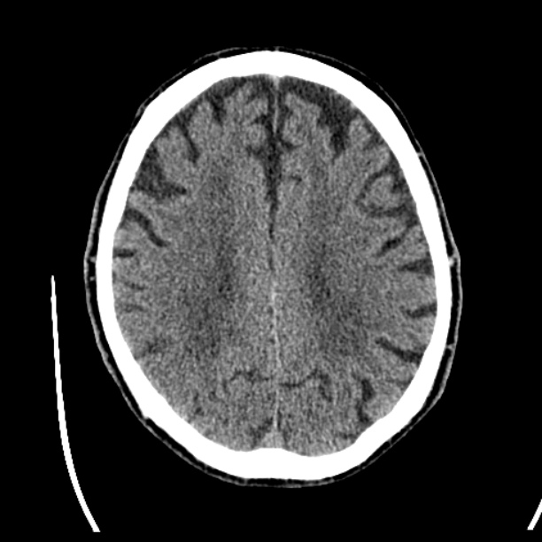Cerebellar hemorrhage (Radiopaedia 27193-27359 Axial non-contrast 35).jpg