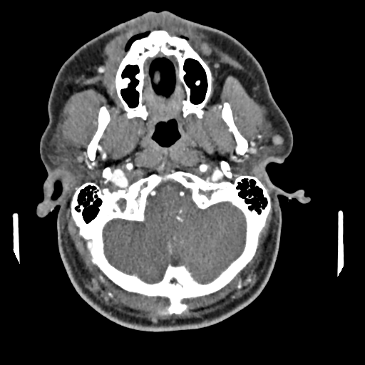 Cerebellar infarct due to vertebral artery dissection with posterior fossa decompression (Radiopaedia 82779-97029 C 41).png