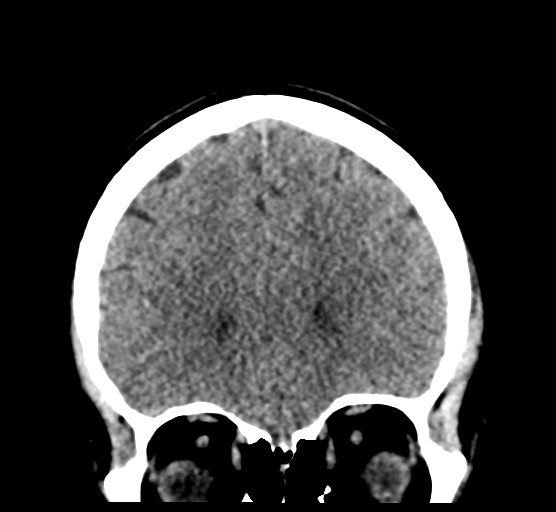 Cerebellar metastases - colorectal adenocarcinoma (Radiopaedia 40947-43652 Coronal non-contrast 29).png