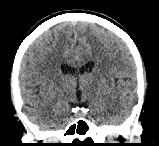 Cerebellar metastases - colorectal adenocarcinoma (Radiopaedia 40947-43652 Coronal non-contrast 48).png