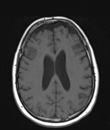 File:Cerebellar metastasis (Radiopaedia 54578-60810 Axial T1 25).png