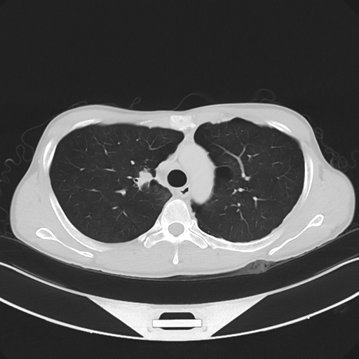 Cerebellar metastasis - adenocarcinoma lung (Radiopaedia 63184-71717 Axial lung window 23).png
