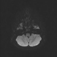 File:Cerebellar stroke (Radiopaedia 32202-33150 Axial DWI 28).png