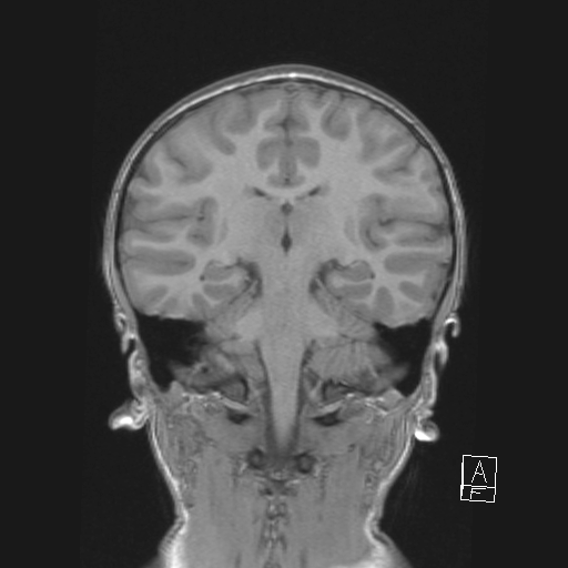 Cerebellar stroke (Radiopaedia 32202-33150 Coronal T1 35).png