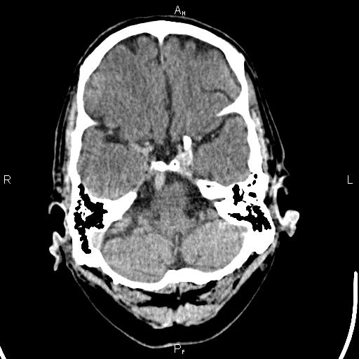 File:Cerebellopontine angle arachnoid cyst (Radiopaedia 85149-100704 Axial With contrast 10).jpg