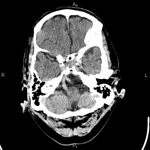 Cerebellopontine angle arachnoid cyst (Radiopaedia 85149-100704 Axial With contrast 8).jpg