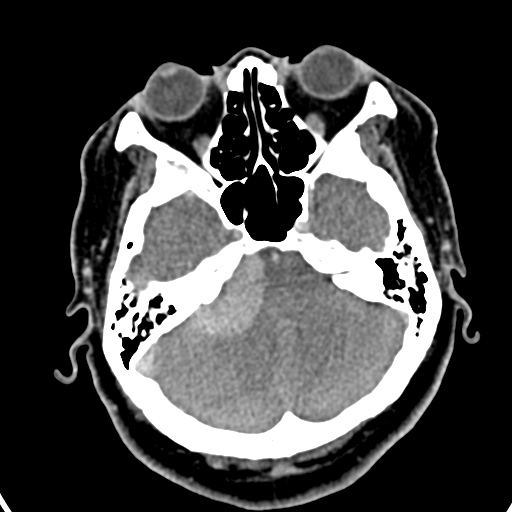 Cerebellopontine angle meningioma (Radiopaedia 35181-36714 A 26).jpg