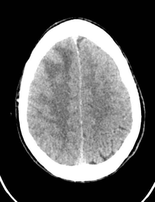 Cerebral abscess (Radiopaedia 60342-68008 Axial non-contrast 40).png