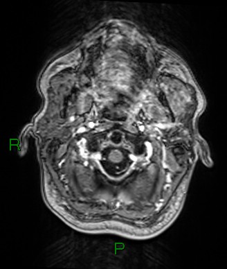 File:Cerebral abscess and subdural empyema (Radiopaedia 84436-99779 Axial T1 C+ 81).jpg
