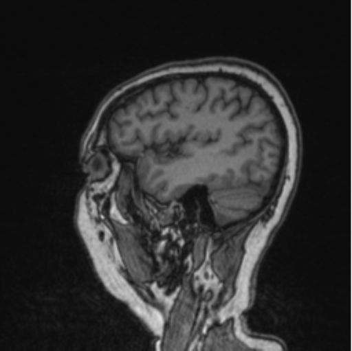 Cerebral abscess from pulmonary arteriovenous malformation (Radiopaedia 86275-102291 Sagittal T1 32).png