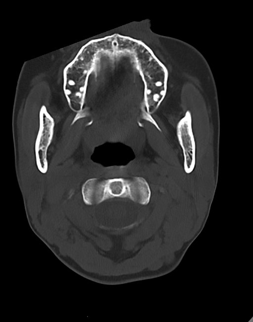 Cerebral abscesses (Radiopaedia 70458-80568 Axial bone window 5).jpg