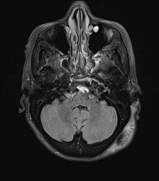 File:Cerebral amyloid angiopathy-related inflammation (Radiopaedia 74836-85849 Axial FLAIR 7).jpg