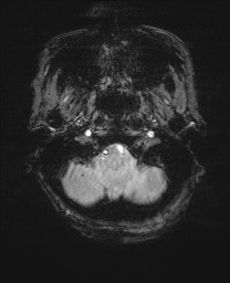 File:Cerebral amyloid angiopathy-related inflammation (Radiopaedia 74836-85849 Axial SWI 8).jpg