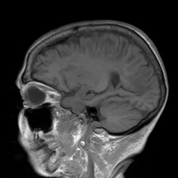 File:Cerebral amyloid angiopathy-related inflammation (Radiopaedia 74836-85849 Sagittal T1 23).jpg