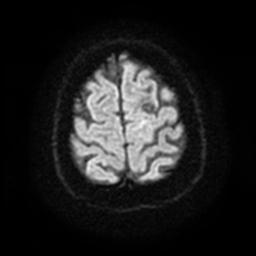 File:Cerebral amyloid angiopathy (Radiopaedia 28698-28978 Axial DWI 26).jpg