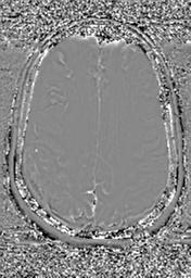 File:Cerebral amyloid angiopathy (Radiopaedia 29129-29518 Axial SWI Phase 25).jpg