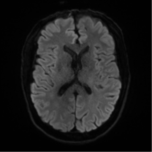 Cerebral amyloid angiopathy (Radiopaedia 46082-50433 Axial DWI 42).png