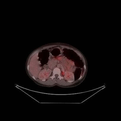 Cerebral and abdominal tuberculosis (Radiopaedia 90499-107853 C 155).jpg