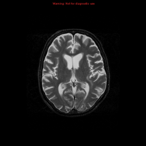 File:Cerebral and orbital tuberculomas (Radiopaedia 13308-13311 Axial T2 12).jpg