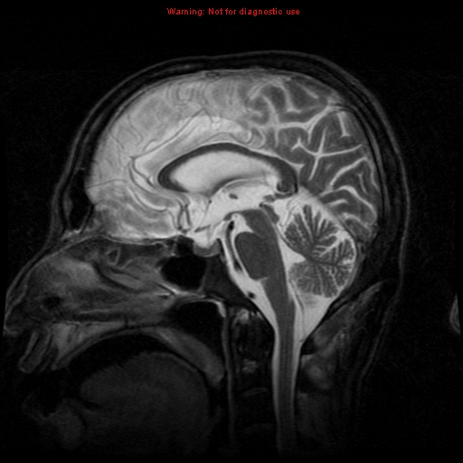 File:Cerebral and orbital tuberculomas (Radiopaedia 13308-13311 Sagittal T2 10).jpg