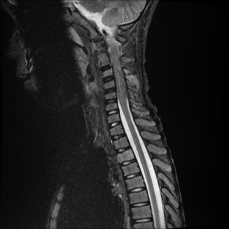 File:Cerebral and spinal tuberculosis (Radiopaedia 90489-107838 Sagittal STIR 5).jpg