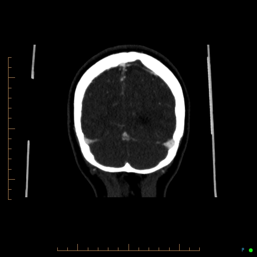 Cerebral arteriovenous malformation (AVM) (Radiopaedia 78162-90706 Coronal CTA 19).jpg
