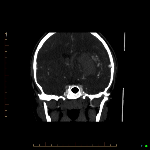 Cerebral arteriovenous malformation (AVM) (Radiopaedia 78162-90706 Coronal CTA 57).jpg