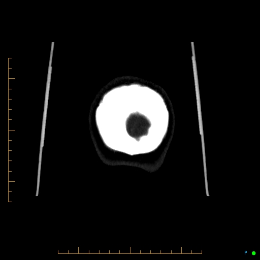 Cerebral arteriovenous malformation (AVM) (Radiopaedia 78162-90706 Coronal CTA 7).jpg