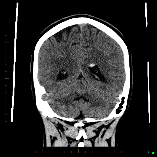 File:Cerebral arteriovenous malformation (AVM) (Radiopaedia 78162-90706 Coronal non-contrast 70).jpg