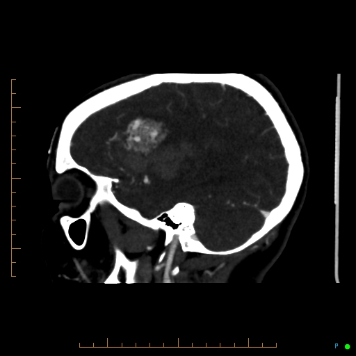 File:Cerebral arteriovenous malformation (AVM) (Radiopaedia 78162-90706 Sagittal CTA 23).jpg