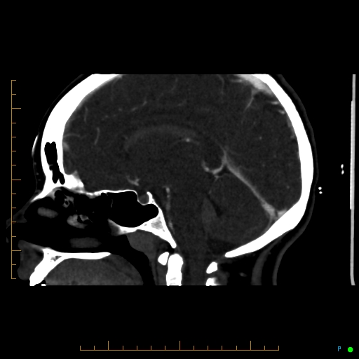 File:Cerebral arteriovenous malformation (AVM) (Radiopaedia 78162-90706 Sagittal CTA 40).jpg