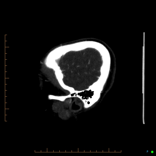 Cerebral arteriovenous malformation (AVM) (Radiopaedia 78162-90706 Sagittal CTA 70).jpg