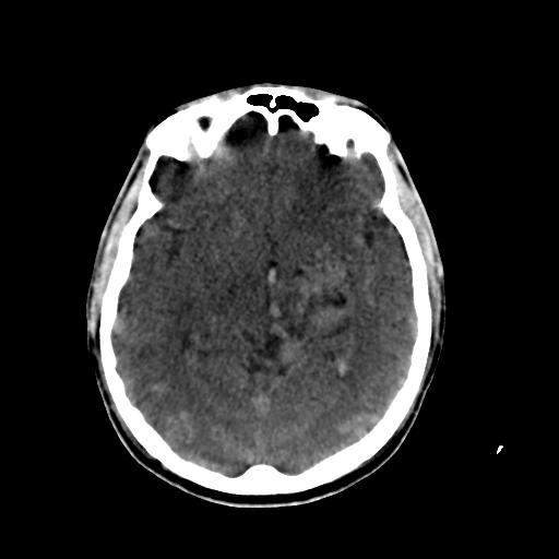 Cerebral arteriovenous malformation (Radiopaedia 28518-28759 Axial non-contrast 33).jpg