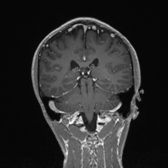 Cerebral arteriovenous malformation (Radiopaedia 30198-30813 F 38).jpg