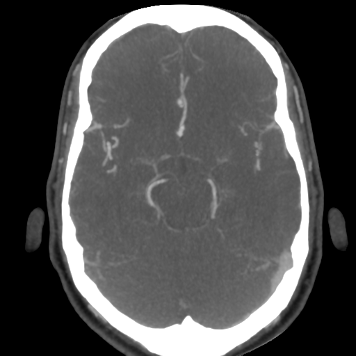 Cerebral arteriovenous malformation (Radiopaedia 39259-41505 AX CEREBRAL CTA 23).png