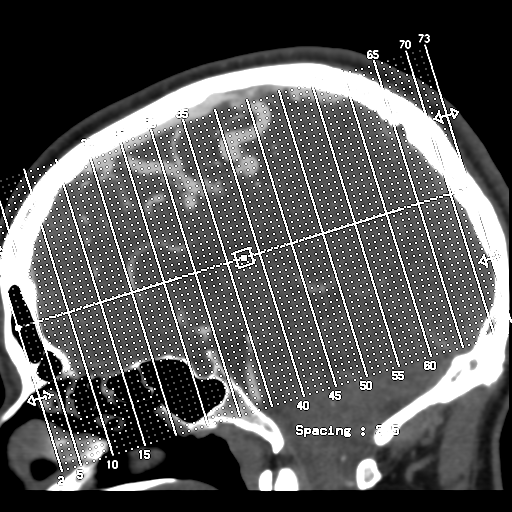 Cerebral arteriovenous malformation (Radiopaedia 39259-41505 E 1).png