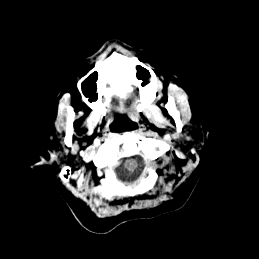 File:Cerebral arteriovenous malformation (Radiopaedia 73830-84645 Axial non-contrast 1).jpg